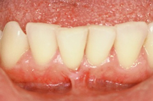 Frenectomy