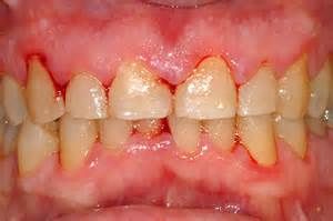 Gingivitis