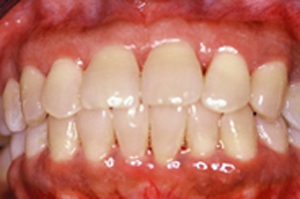 Periodontal  Treatment